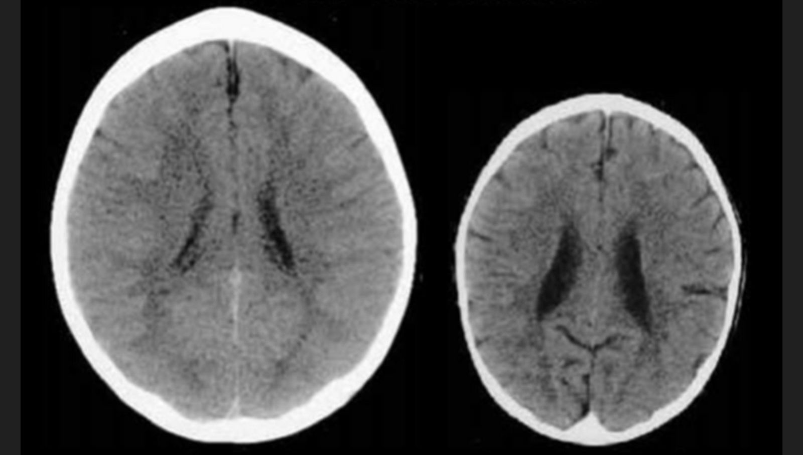 The brains of two 3 year-olds, one nurtured and one neglected.